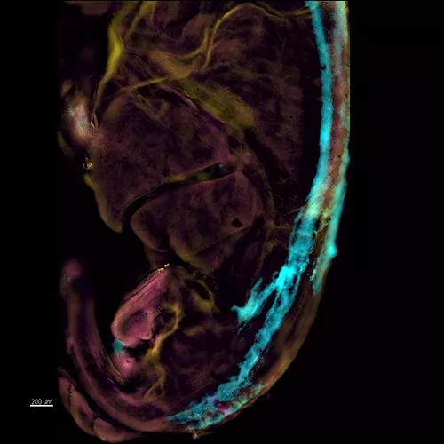 Sacrococcygeal Teratomas (SCTs)